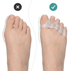 Alternative view of OrthoRelax® – Gel separator za prste (2 separatora)