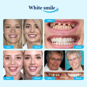 Alternative view of WHITESMILE™ – Podesiva Kozmetička Zubna Faseta